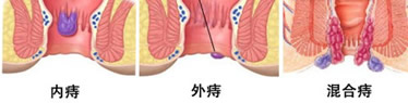 如何判断自己是否得了痔疮